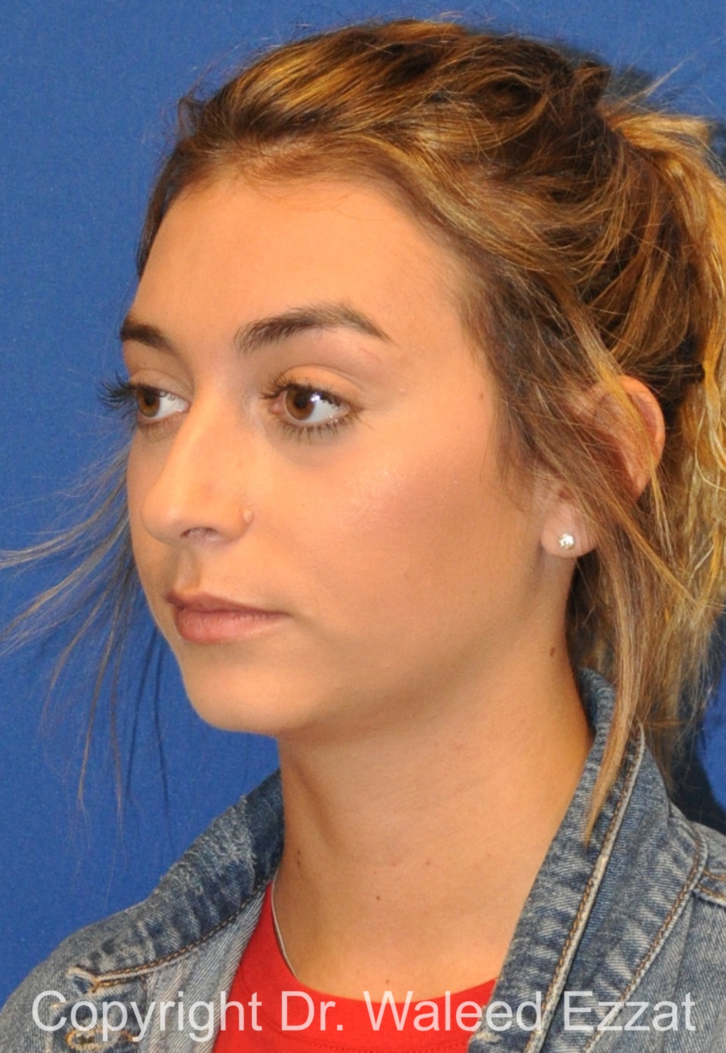 Mediterranean/Middle Eastern Rhinoplasty Patient Photo - Case 39 - before view-1