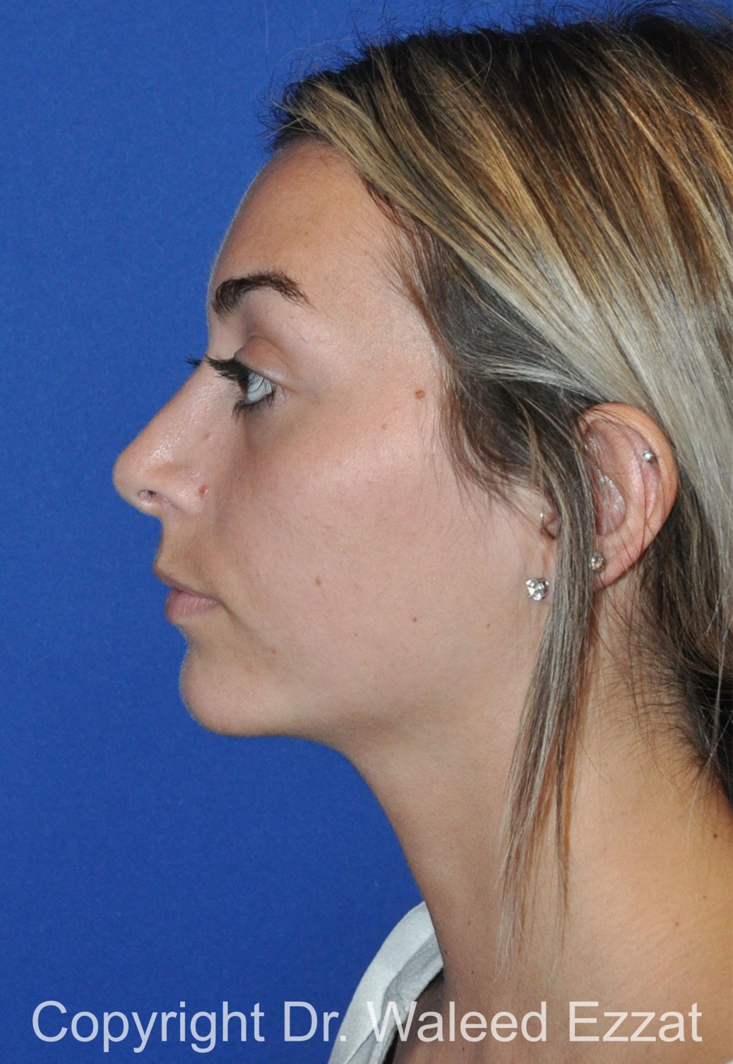 Mediterranean/Middle Eastern Rhinoplasty Patient Photo - Case 39 - after view