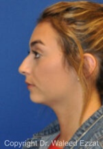 Mediterranean/Middle Eastern Rhinoplasty - Case 39 - Before