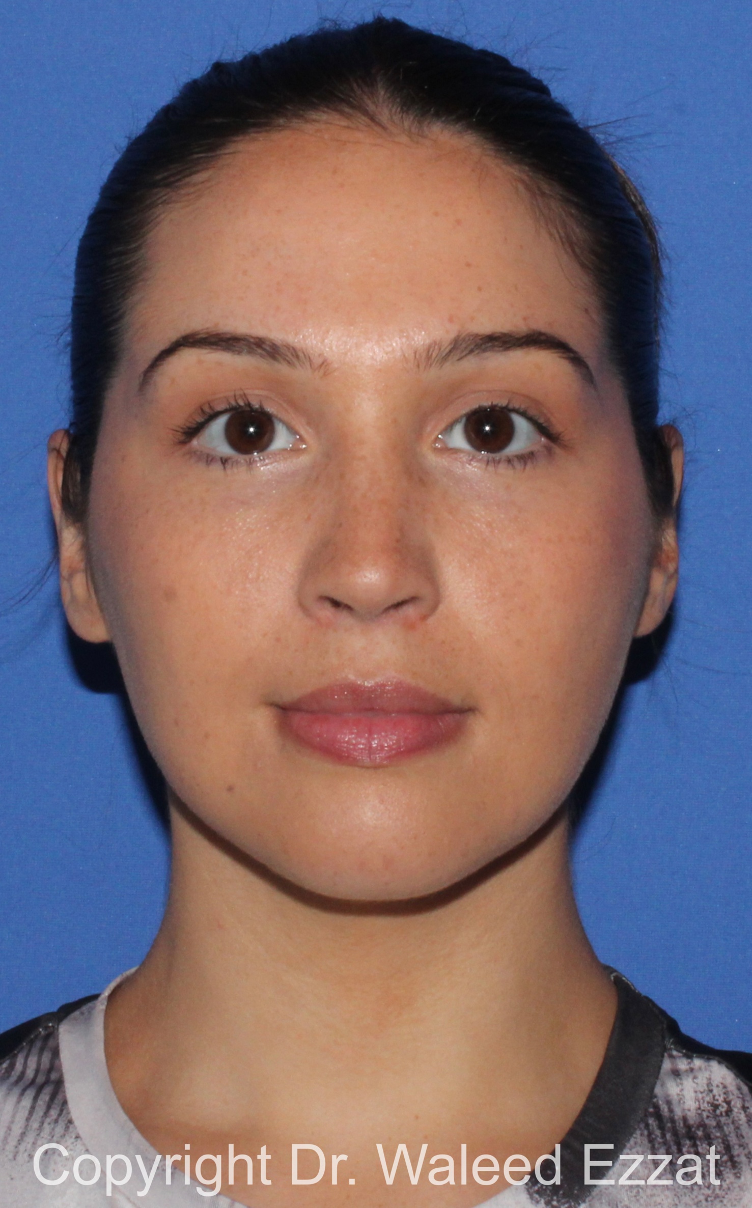 Mediterranean/Middle Eastern Rhinoplasty Patient Photo - Case 90 - after view-2