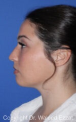 Mediterranean/Middle Eastern Rhinoplasty - Case 90 - Before