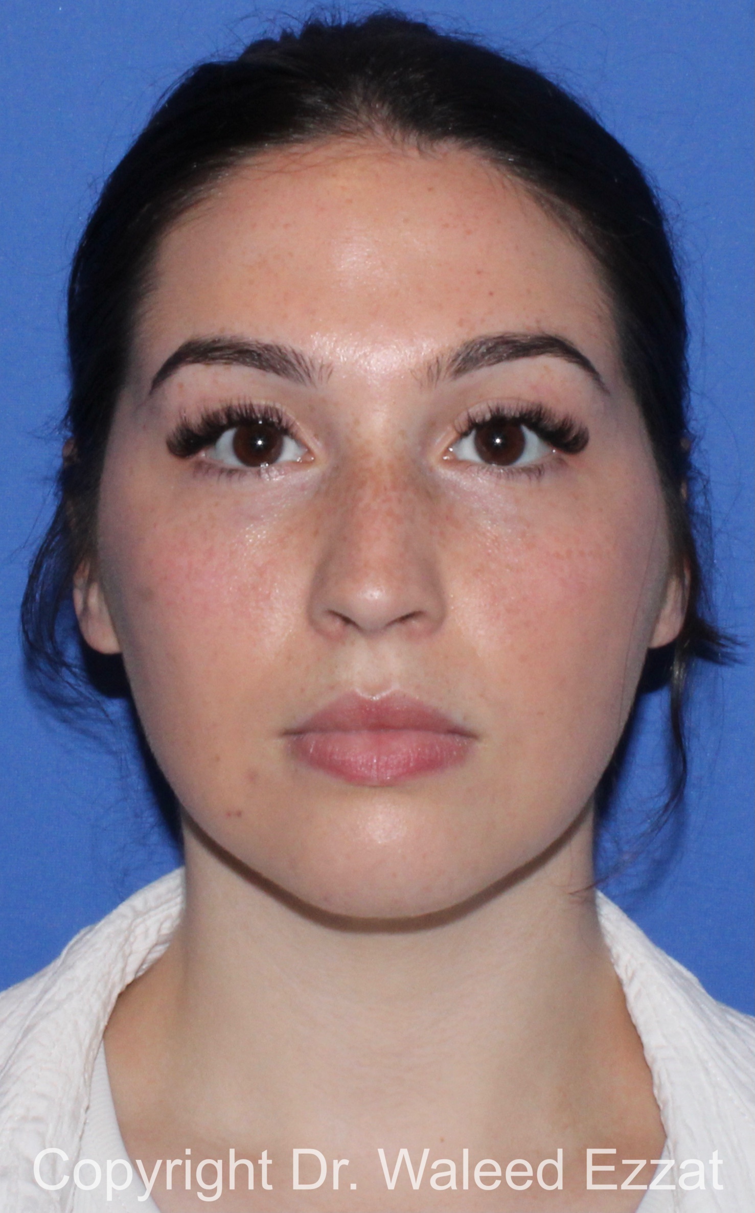 Mediterranean/Middle Eastern Rhinoplasty Patient Photo - Case 90 - before view-2