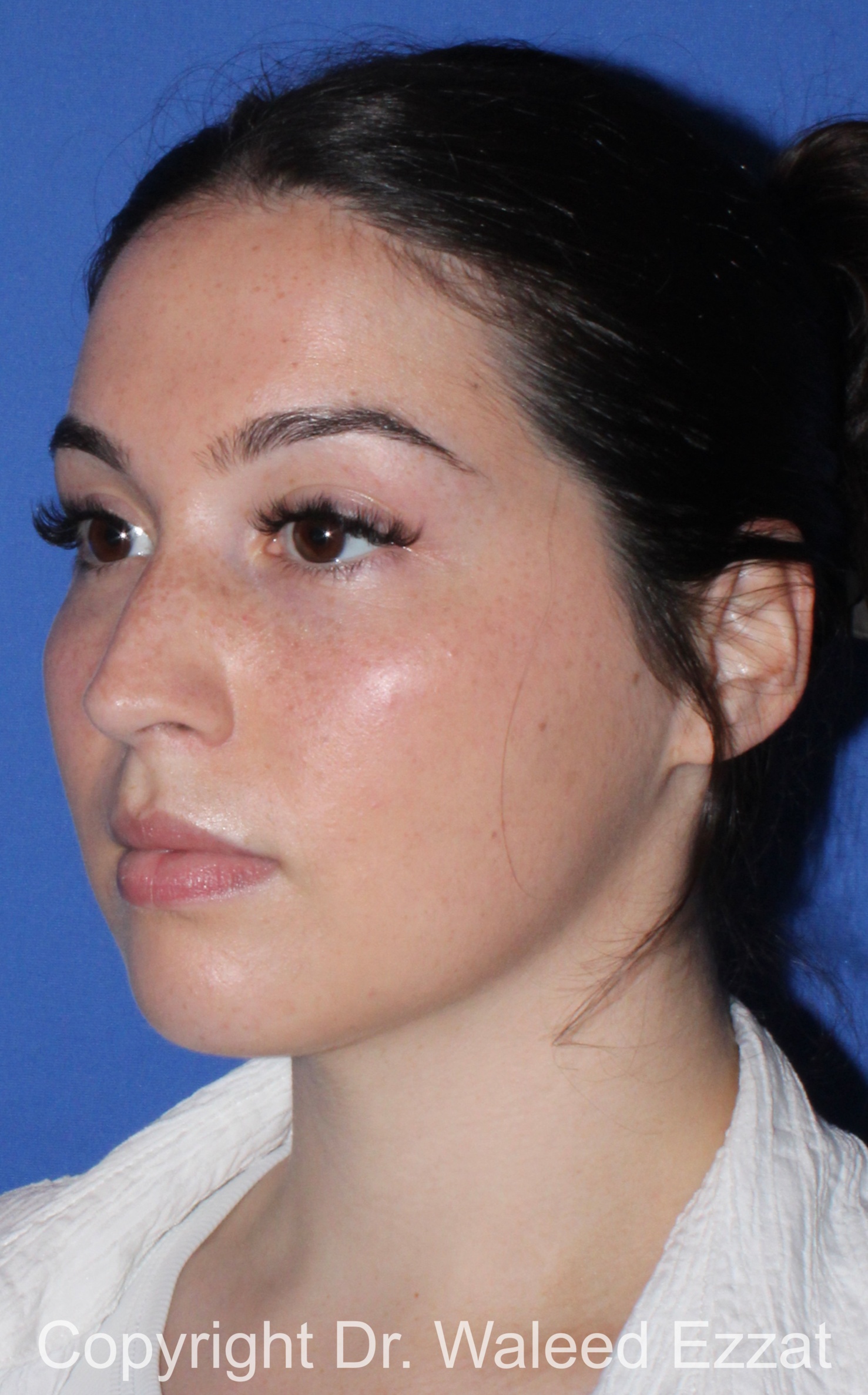 Mediterranean/Middle Eastern Rhinoplasty Patient Photo - Case 90 - before view-1
