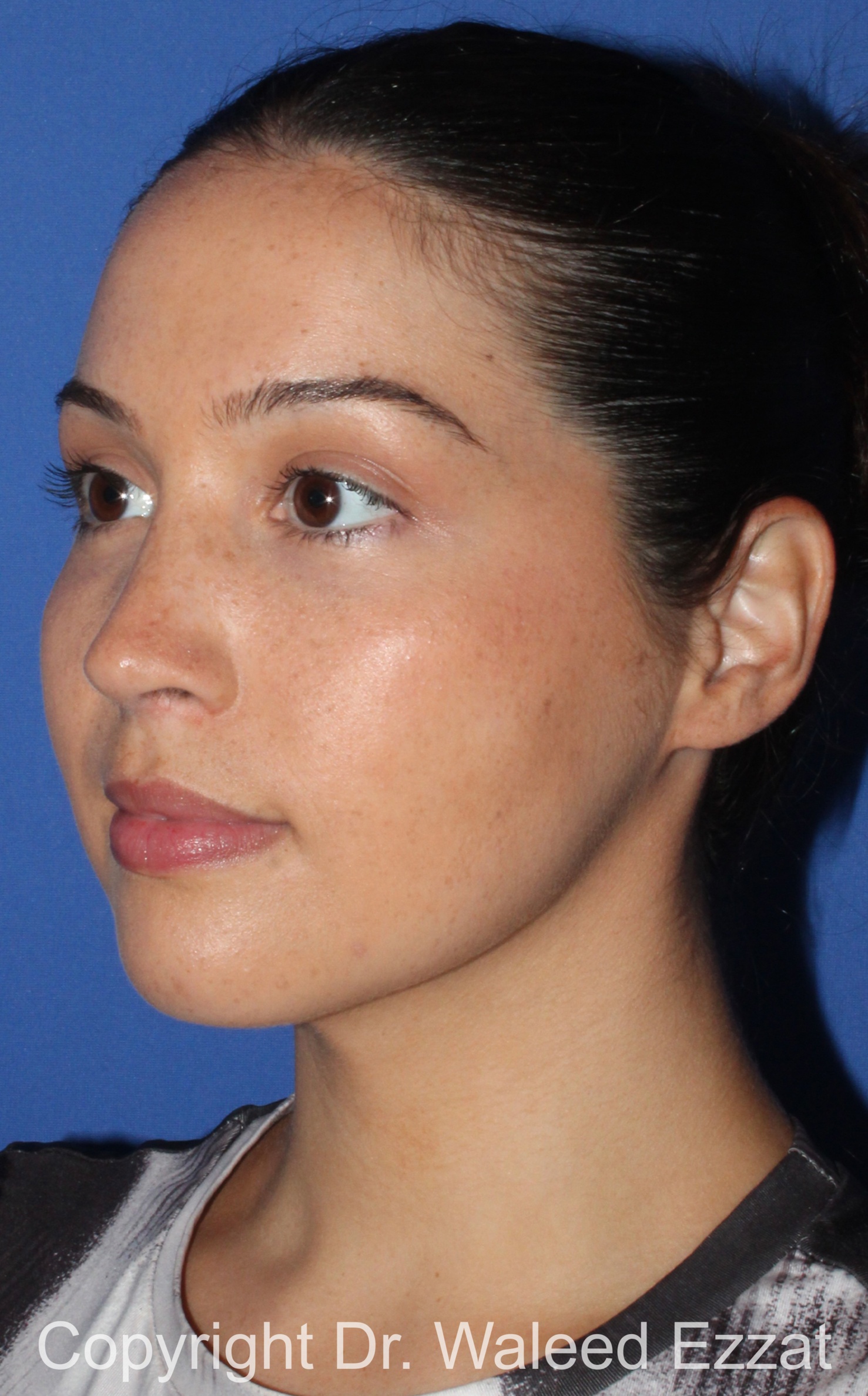 Mediterranean/Middle Eastern Rhinoplasty Patient Photo - Case 90 - after view-1
