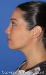 Mediterranean/Middle Eastern Rhinoplasty - Case 90 - After