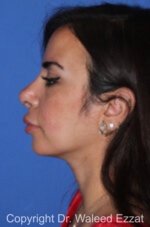 Mediterranean/Middle Eastern Rhinoplasty - Case 91 - After