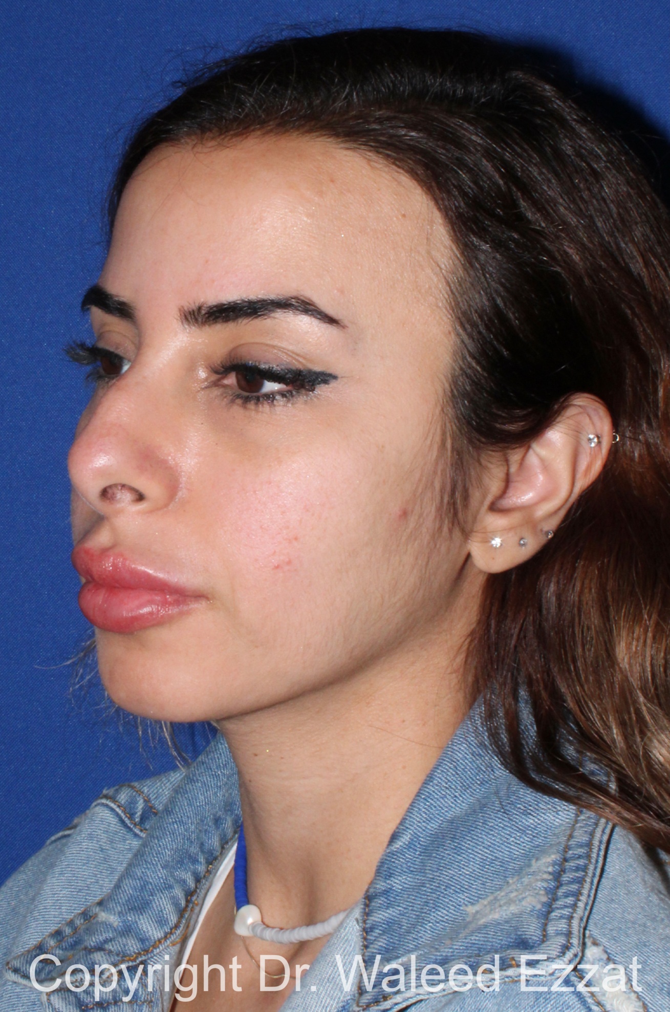 Rhinoplasty Patient Photo - Case 91 - before view-1