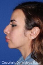 Mediterranean/Middle Eastern Rhinoplasty - Case 91 - Before
