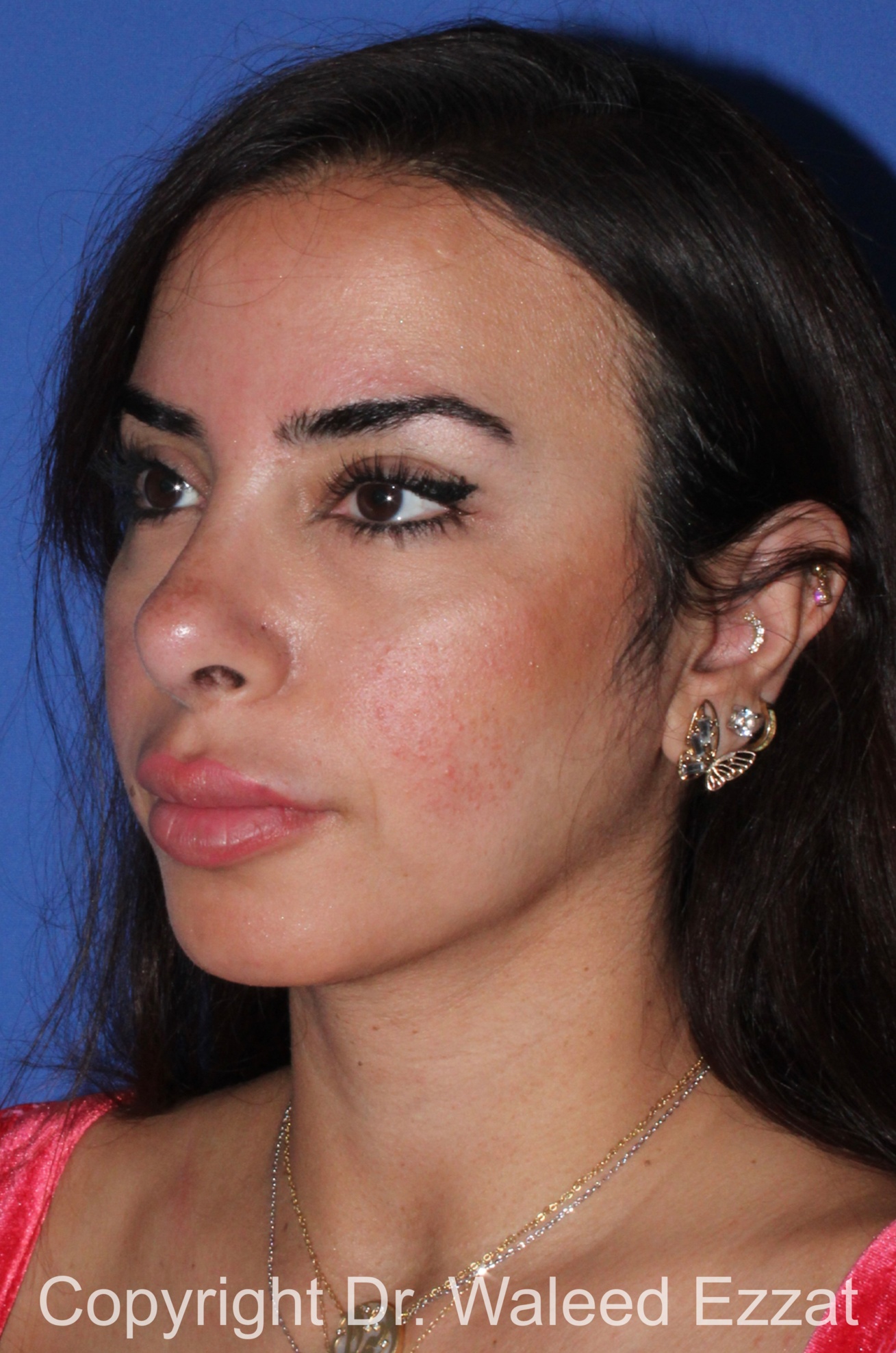 Rhinoplasty Patient Photo - Case 91 - after view-1