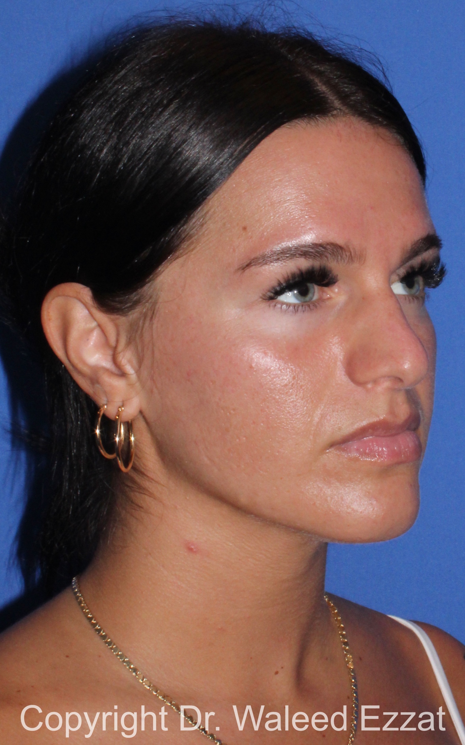 Mediterranean/Middle Eastern Rhinoplasty Patient Photo - Case 92 - before view-1