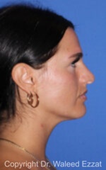 Mediterranean/Middle Eastern Rhinoplasty - Case 92 - Before