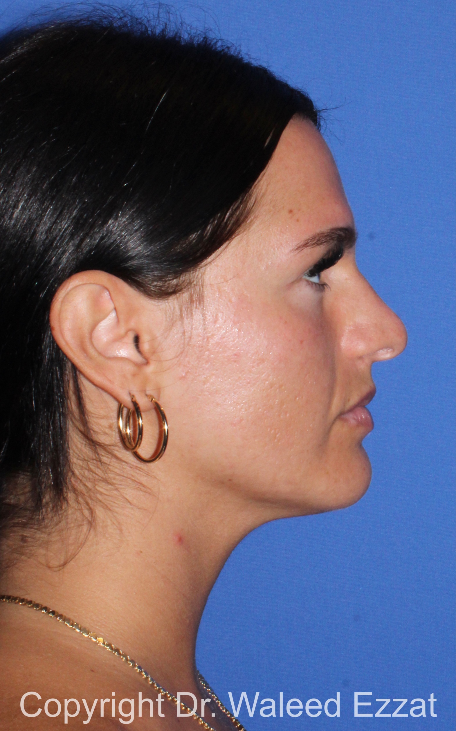 Mediterranean/Middle Eastern Rhinoplasty Patient Photo - Case 92 - before view-