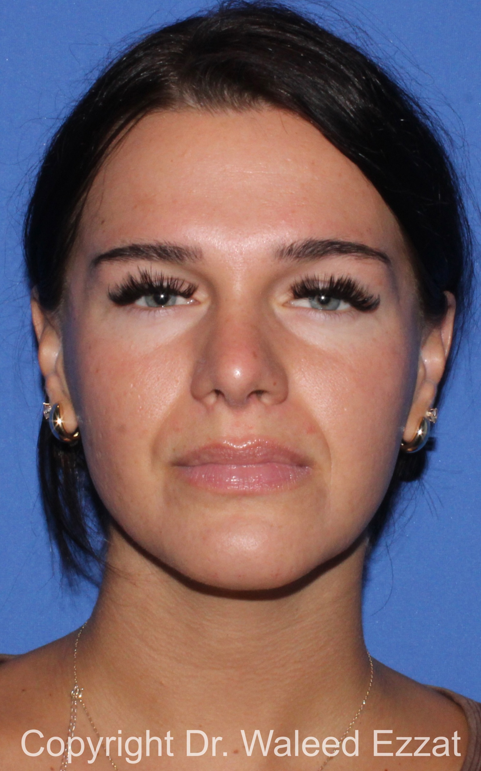 Mediterranean/Middle Eastern Rhinoplasty Patient Photo - Case 92 - after view-2