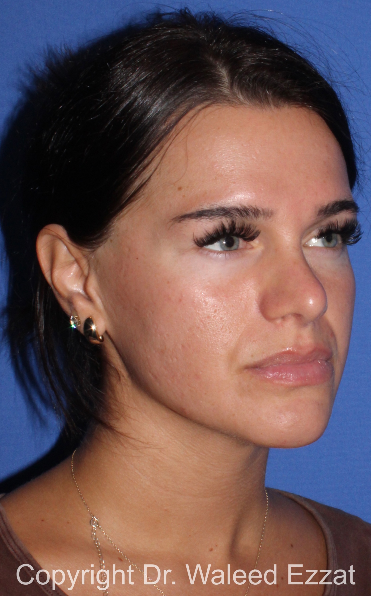 Mediterranean/Middle Eastern Rhinoplasty Patient Photo - Case 92 - after view-1