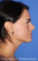 Mediterranean/Middle Eastern Rhinoplasty - Case 92 - After
