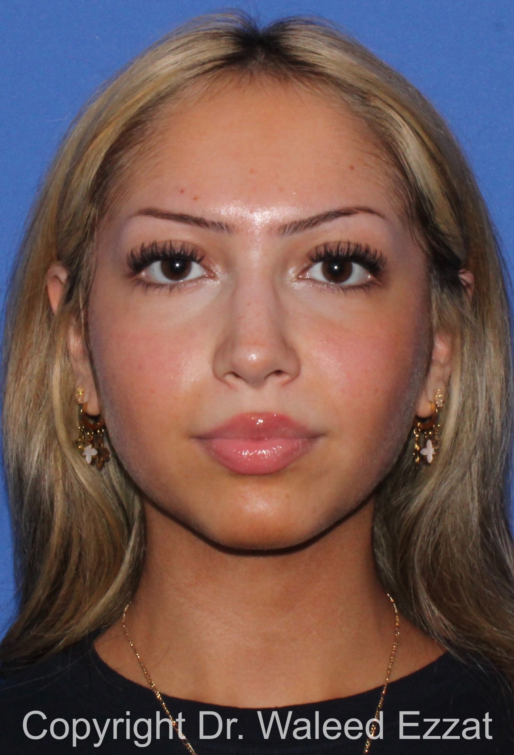 Mediterranean/Middle Eastern Rhinoplasty Patient Photo - Case 94 - after view-2