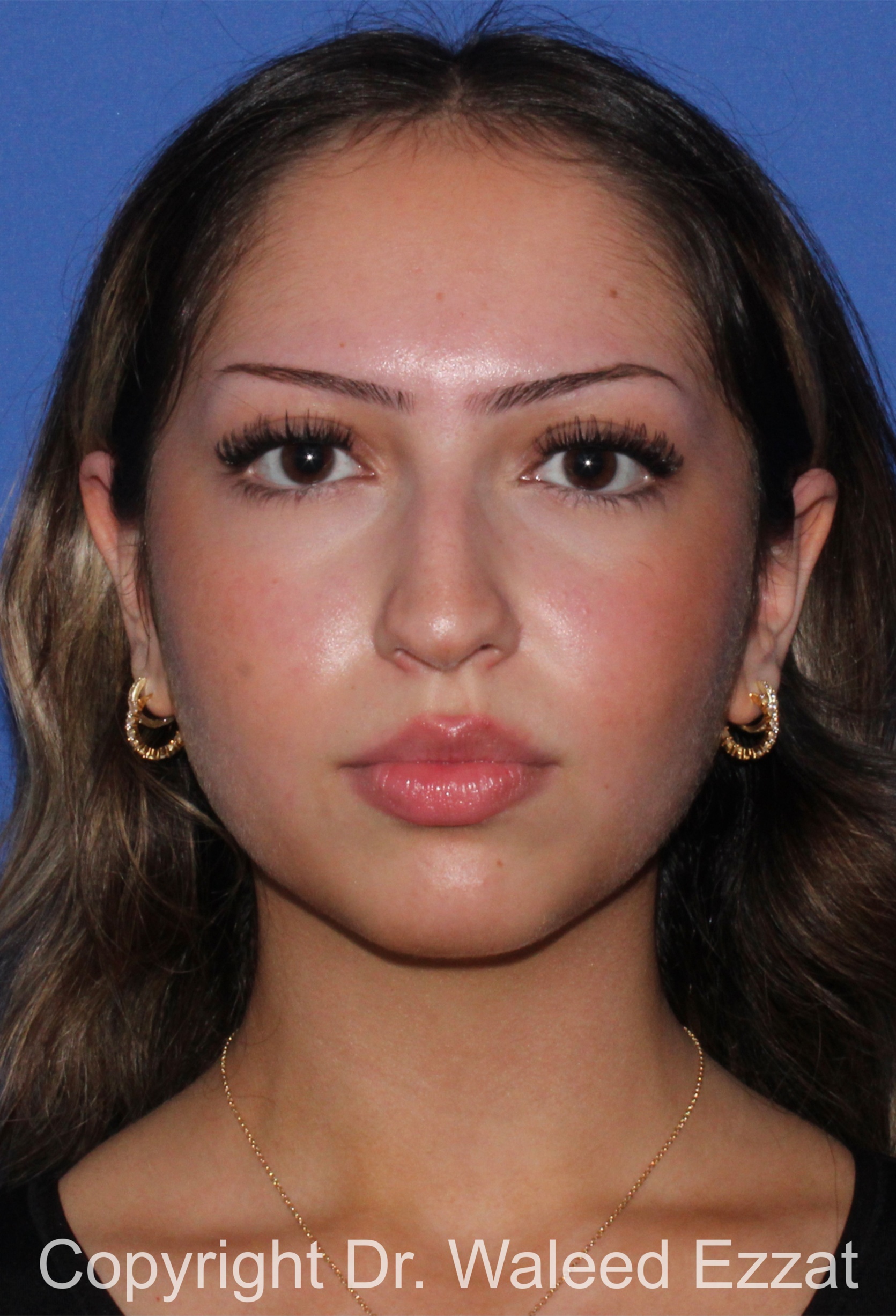 Mediterranean/Middle Eastern Rhinoplasty Patient Photo - Case 94 - before view-2