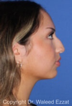 Mediterranean/Middle Eastern Rhinoplasty - Case 94 - Before