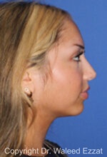 Mediterranean/Middle Eastern Rhinoplasty - Case 94 - After