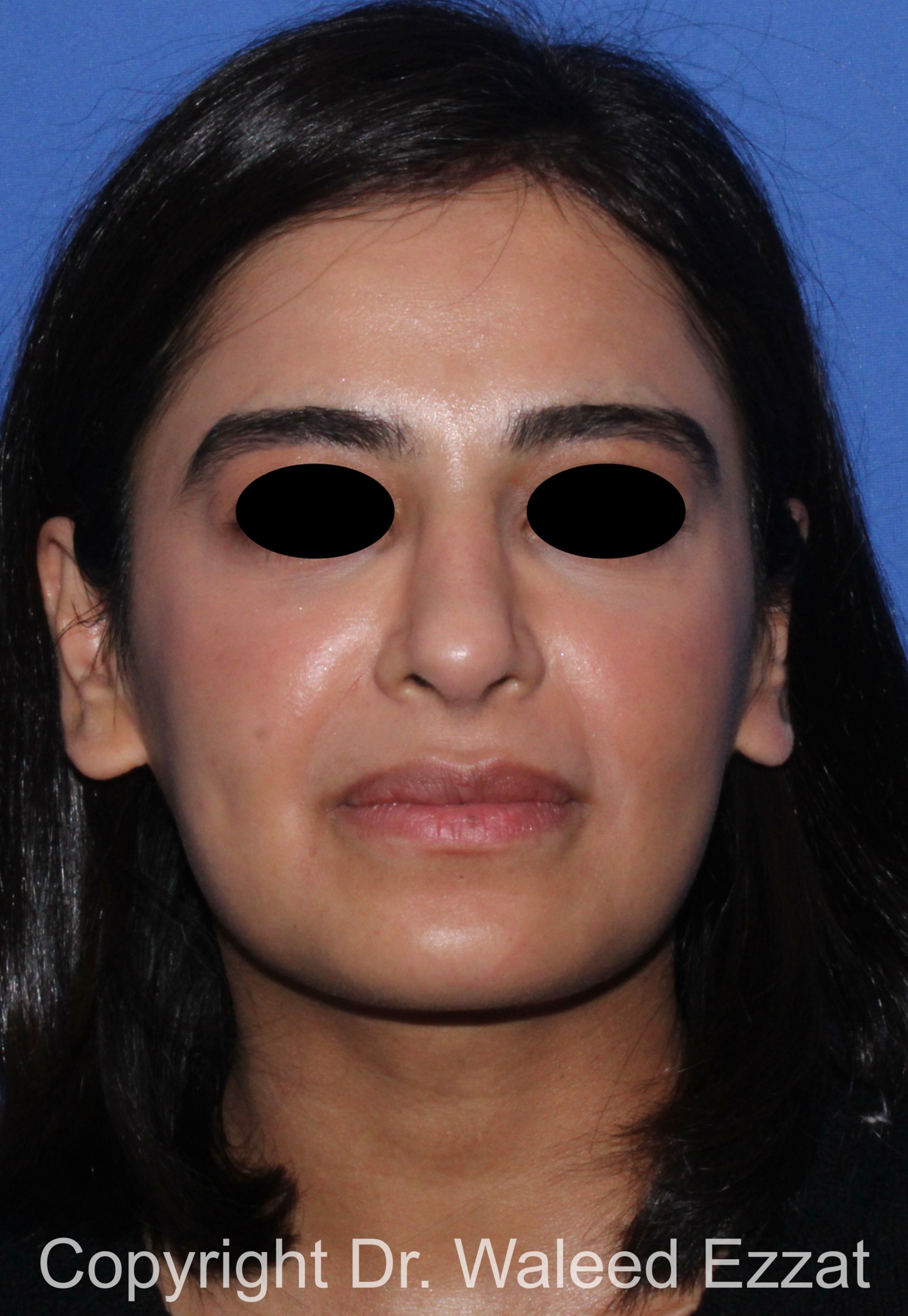 Mediterranean/Middle Eastern Rhinoplasty Patient Photo - Case 95 - after view-2