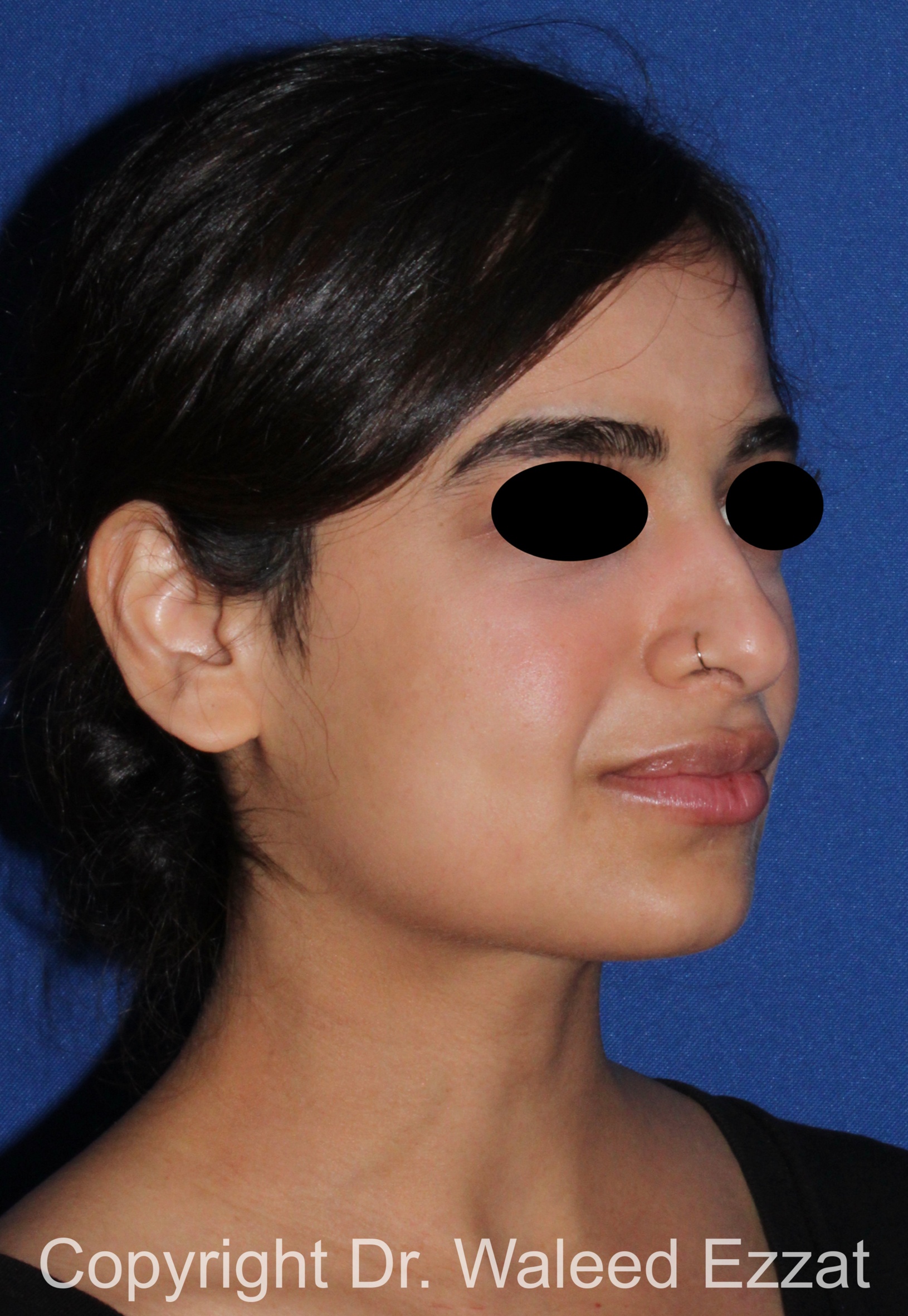 Mediterranean/Middle Eastern Rhinoplasty Patient Photo - Case 95 - before view-1