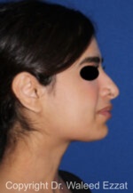 Mediterranean/Middle Eastern Rhinoplasty - Case 95 - Before