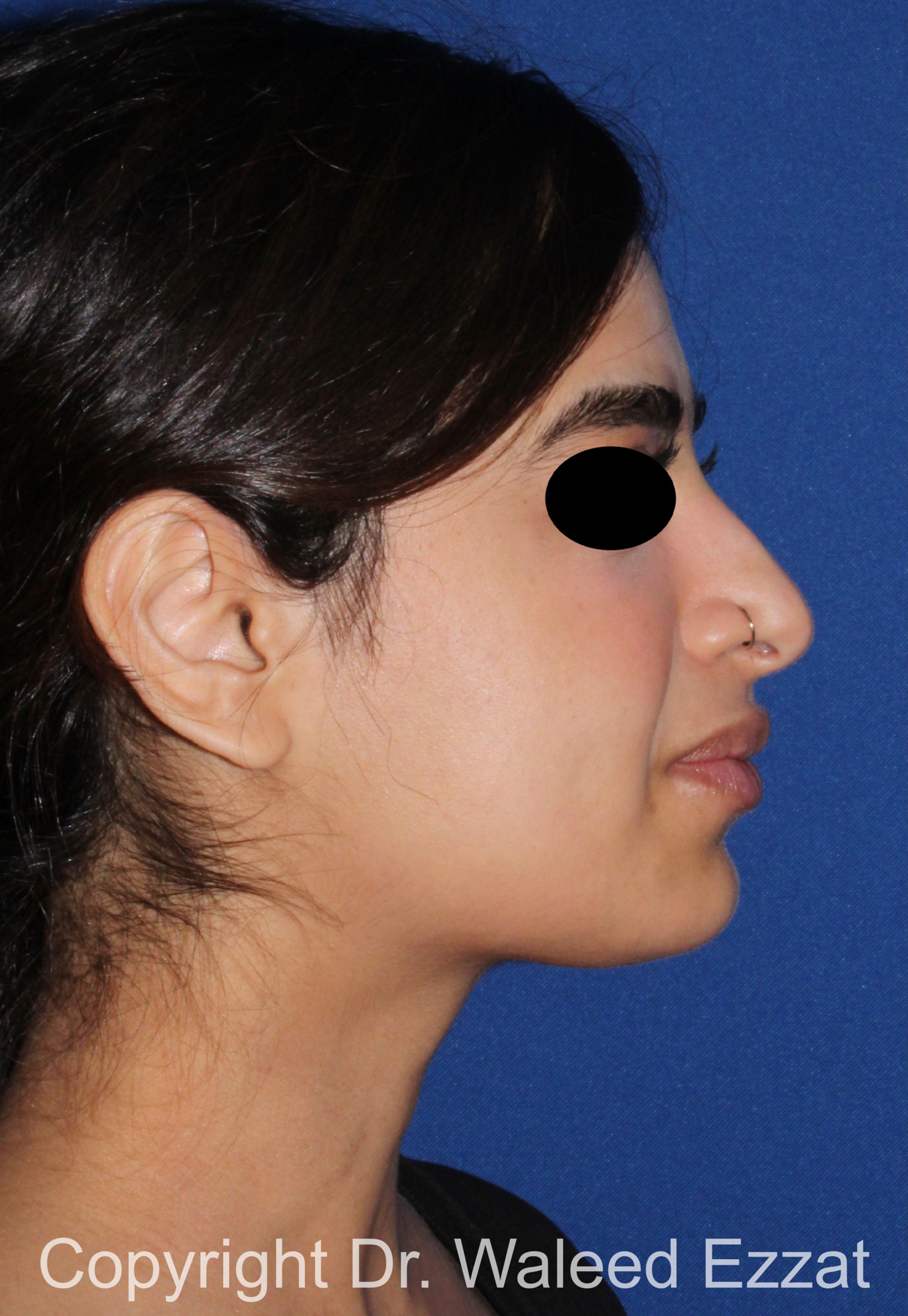 Mediterranean/Middle Eastern Rhinoplasty Patient Photo - Case 95 - before view-