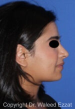 Mediterranean/Middle Eastern Rhinoplasty - Case 95 - After