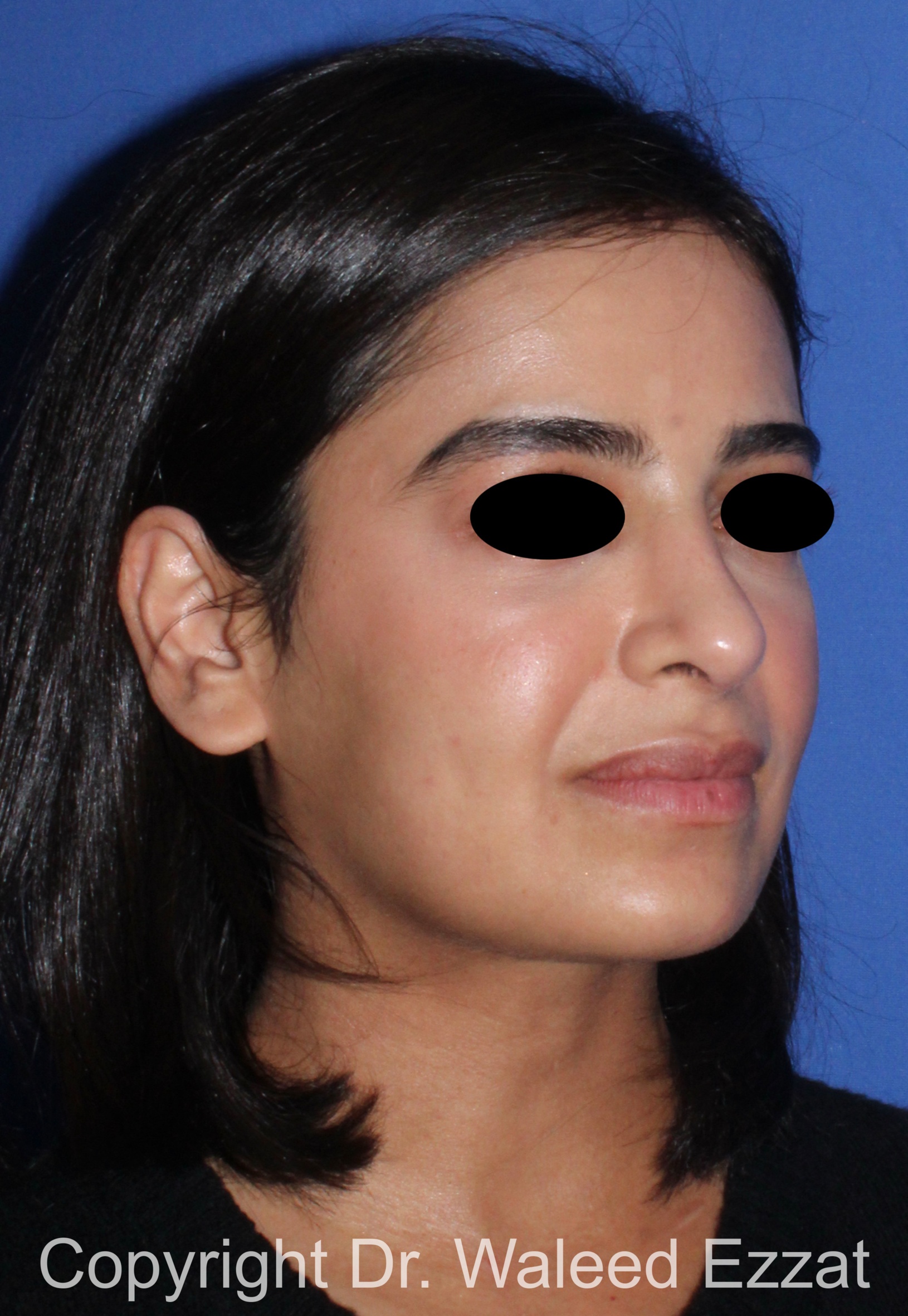 Mediterranean/Middle Eastern Rhinoplasty Patient Photo - Case 95 - after view-1