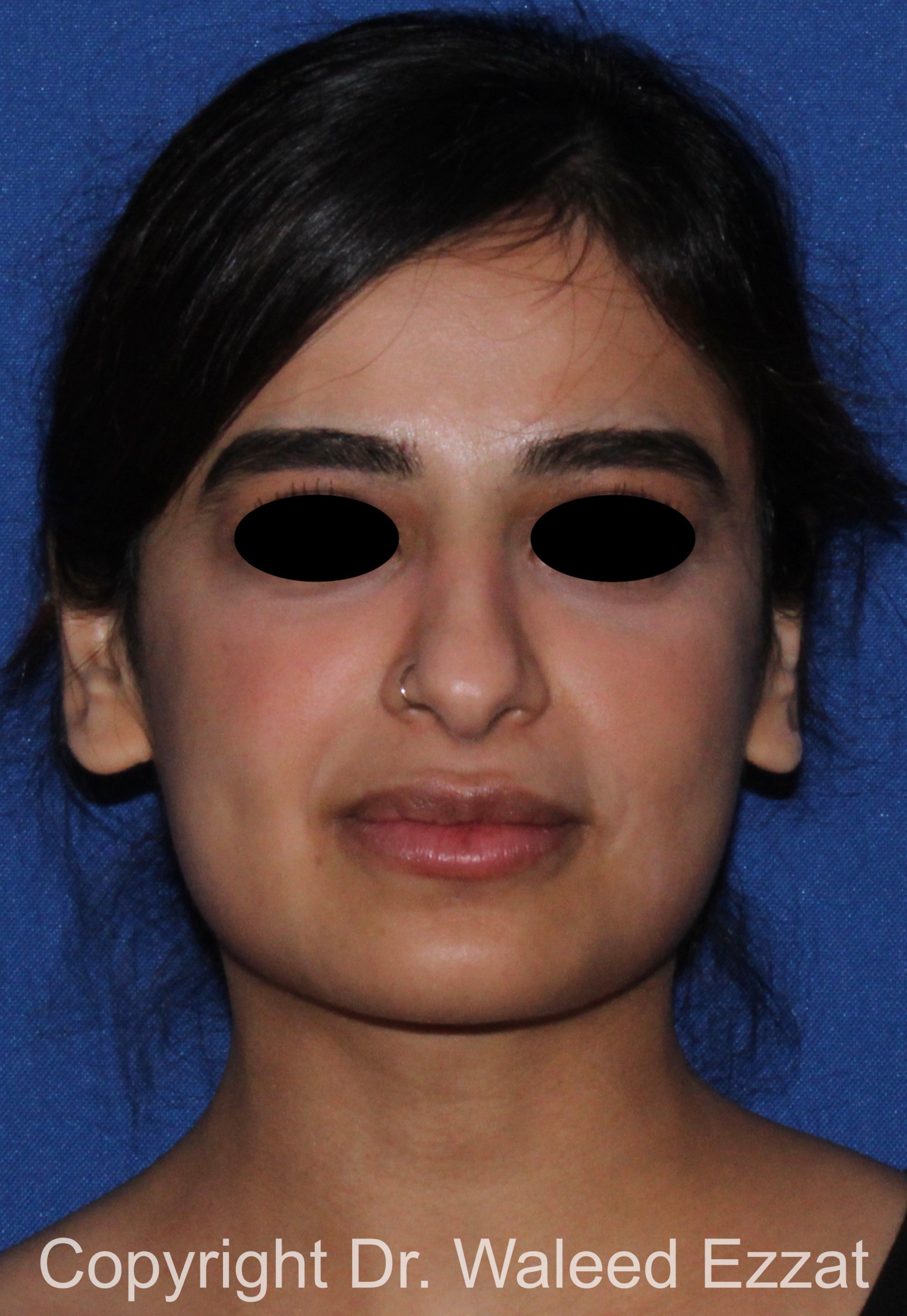 Mediterranean/Middle Eastern Rhinoplasty Patient Photo - Case 95 - before view-2
