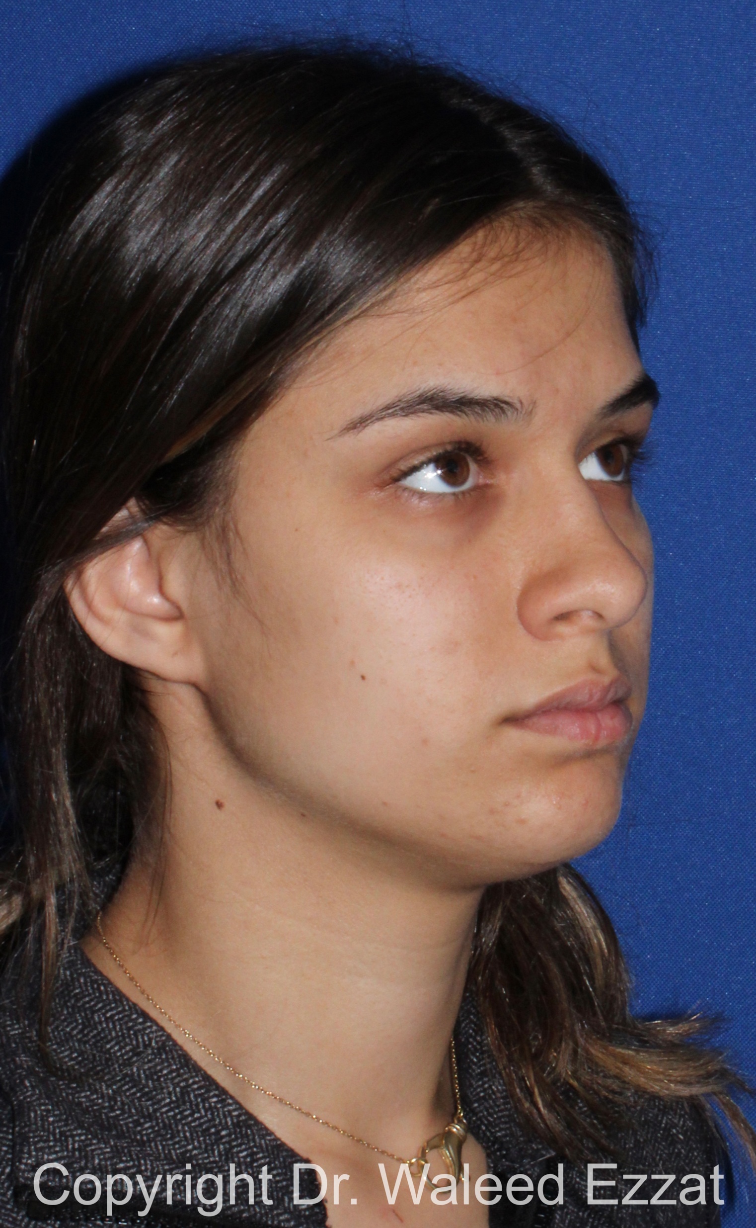 Mediterranean/Middle Eastern Rhinoplasty Patient Photo - Case 651 - before view-1