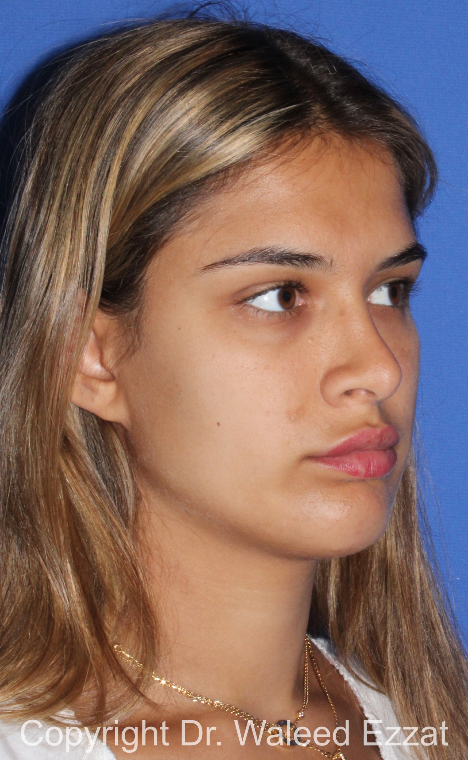 Mediterranean/Middle Eastern Rhinoplasty Patient Photo - Case 651 - after view-1