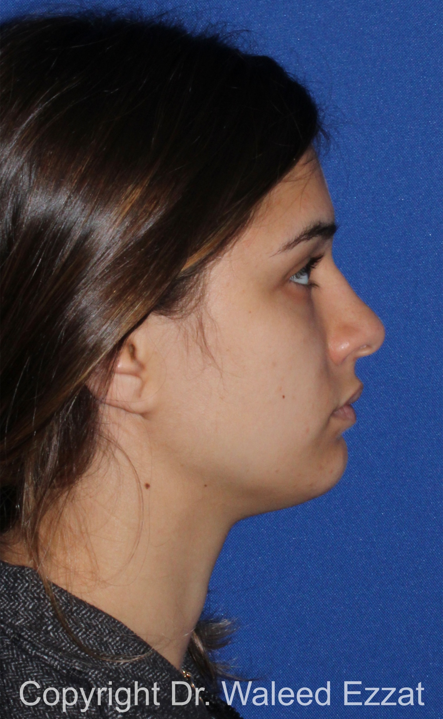 Mediterranean/Middle Eastern Rhinoplasty Patient Photo - Case 651 - before view-