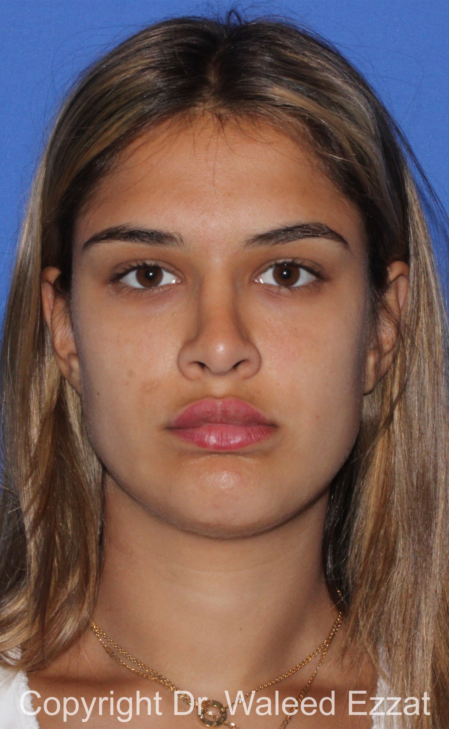 Mediterranean/Middle Eastern Rhinoplasty Patient Photo - Case 651 - after view-2