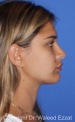 Mediterranean/Middle Eastern Rhinoplasty - Case 651 - After
