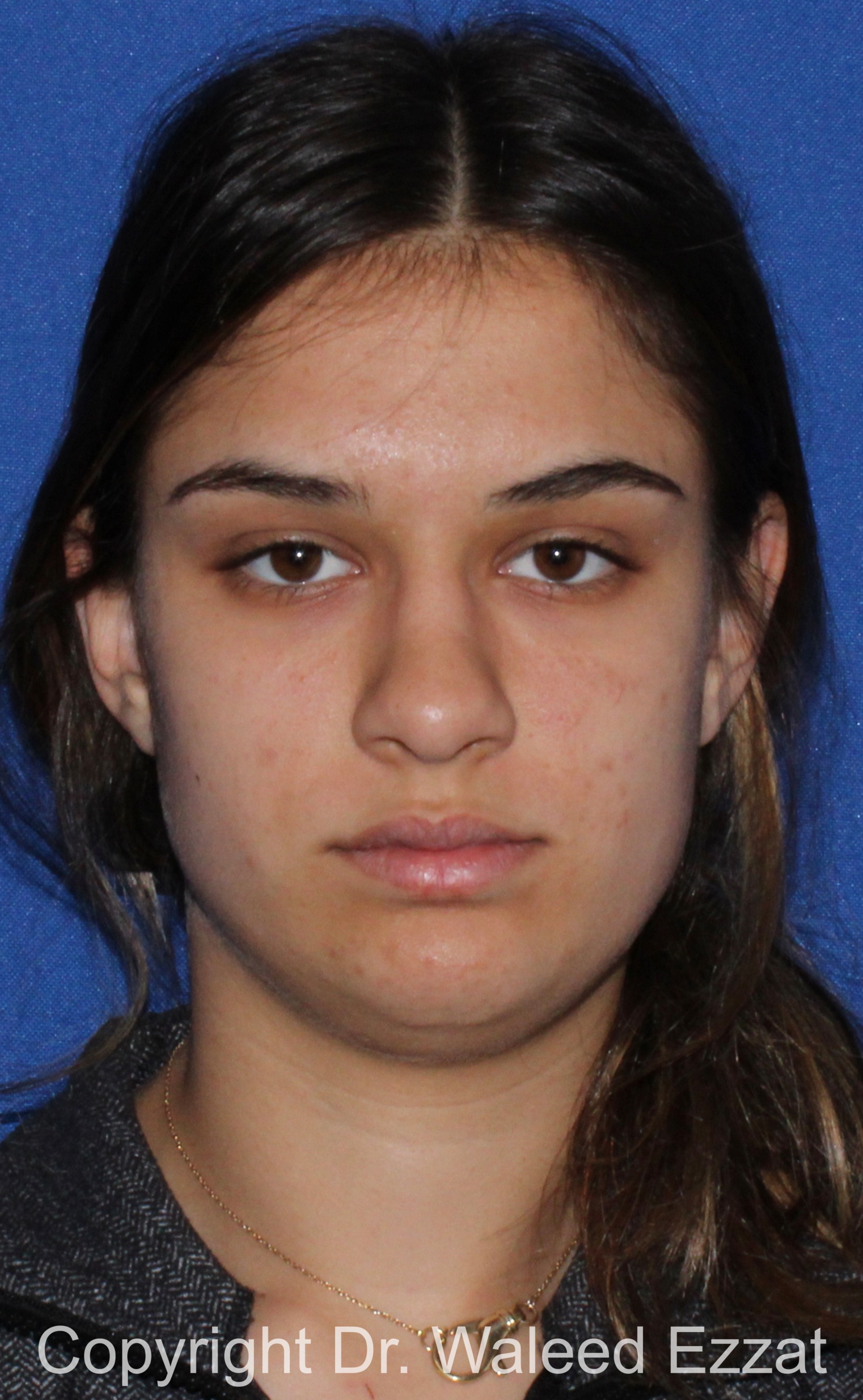 Mediterranean/Middle Eastern Rhinoplasty Patient Photo - Case 651 - before view-2