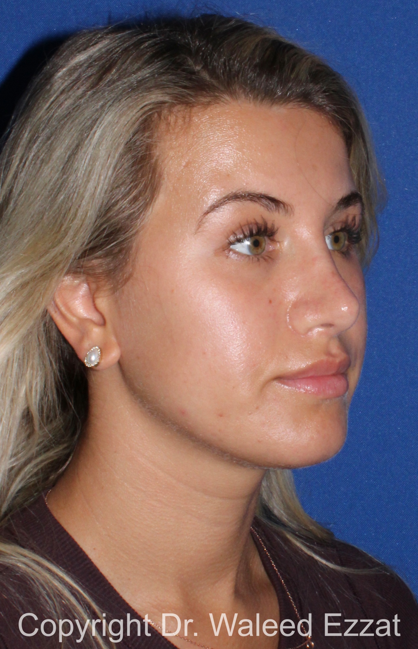 Mediterranean/Middle Eastern Rhinoplasty Patient Photo - Case 652 - after view-2