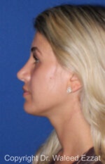 Mediterranean/Middle Eastern Rhinoplasty - Case 652 - After