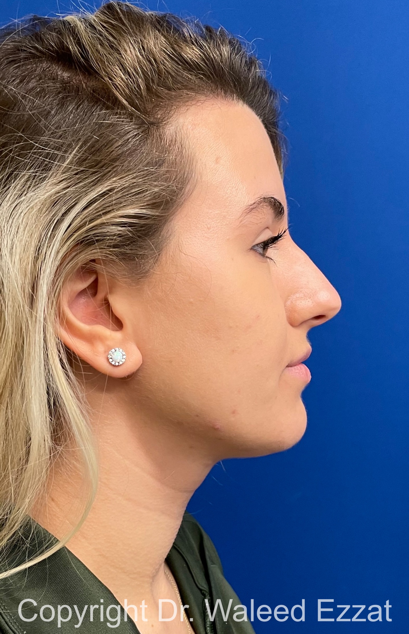 Mediterranean/Middle Eastern Rhinoplasty Patient Photo - Case 652 - before view-3