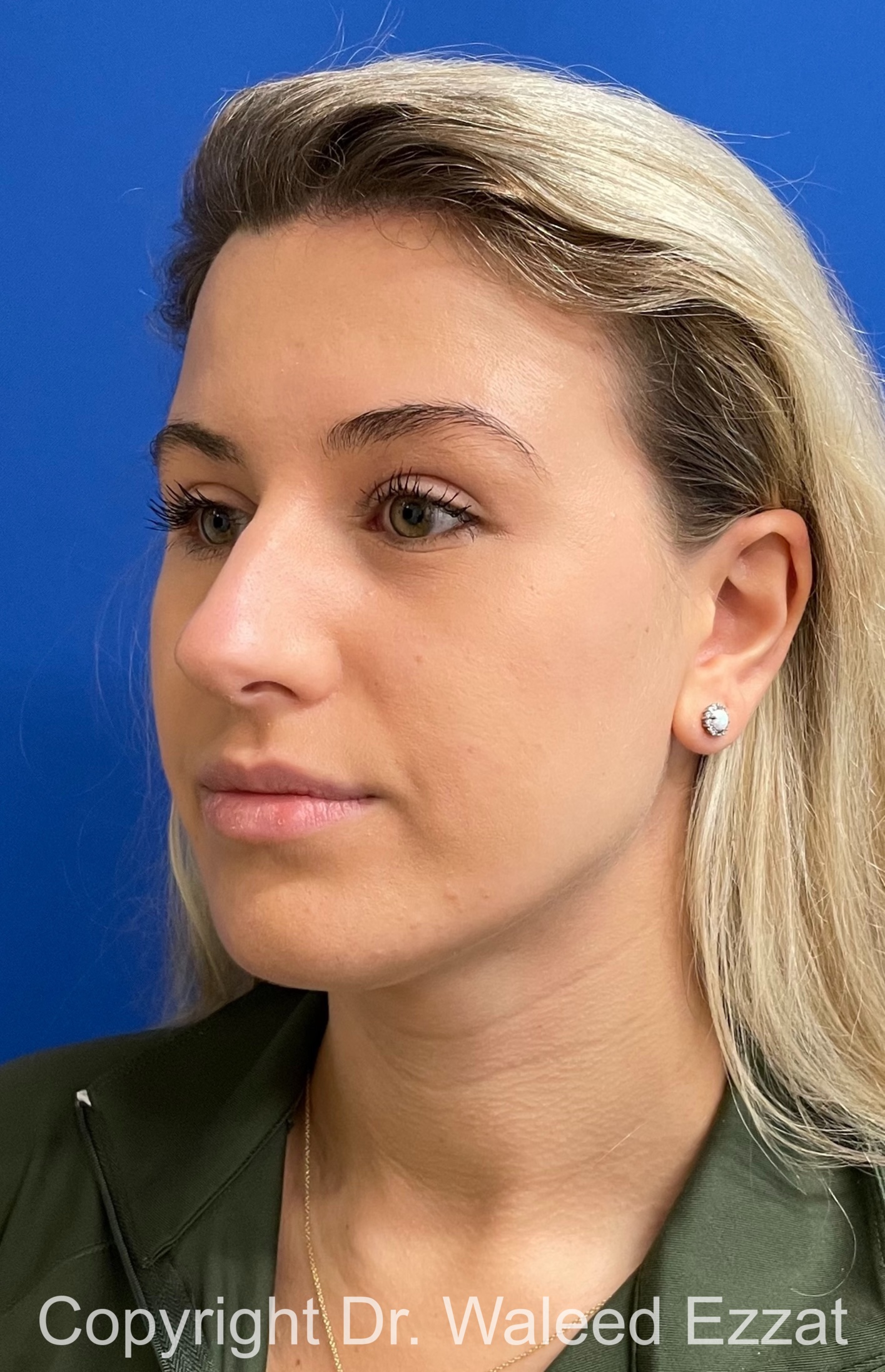 Mediterranean/Middle Eastern Rhinoplasty Patient Photo - Case 652 - before view-1