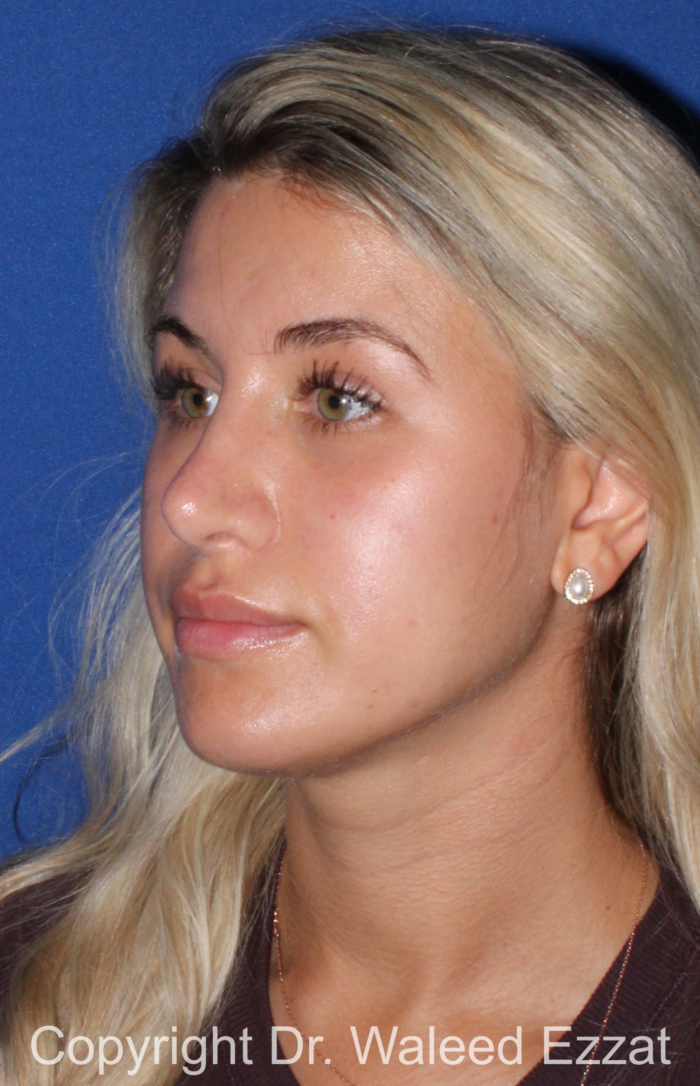Mediterranean/Middle Eastern Rhinoplasty Patient Photo - Case 652 - after view-1