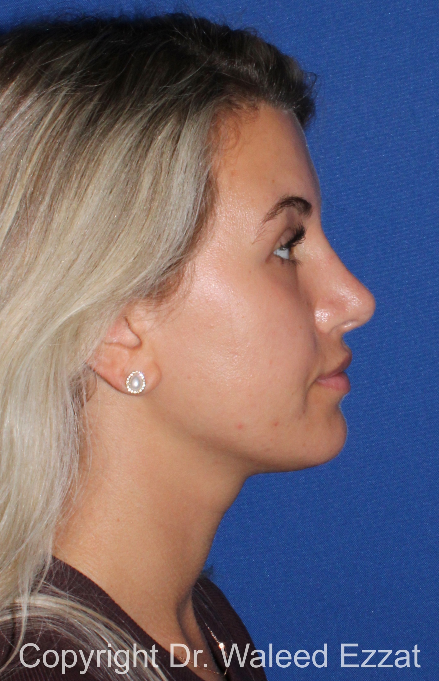 Mediterranean/Middle Eastern Rhinoplasty Patient Photo - Case 652 - after view-3