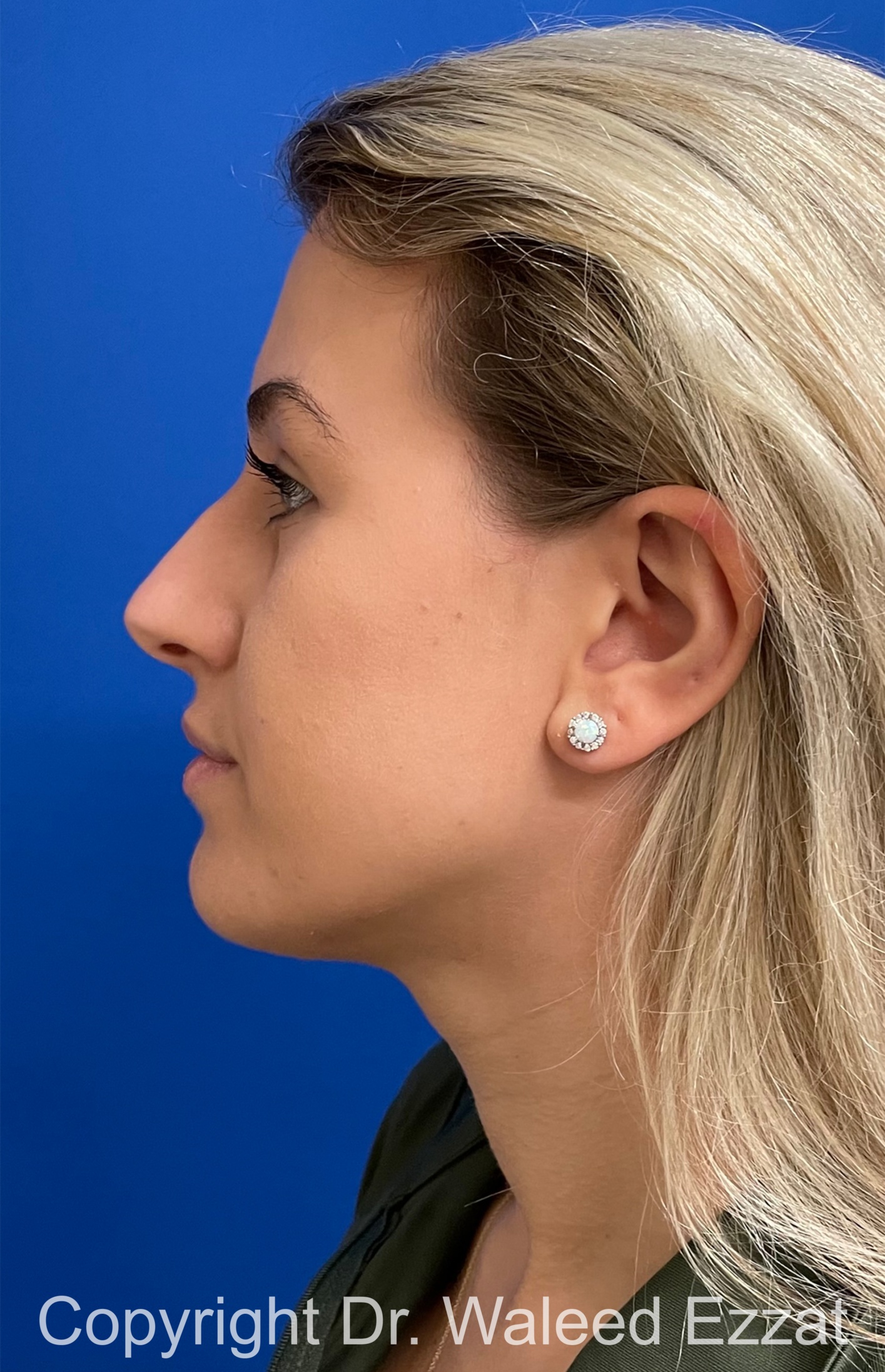 Mediterranean/Middle Eastern Rhinoplasty Patient Photo - Case 652 - before view-