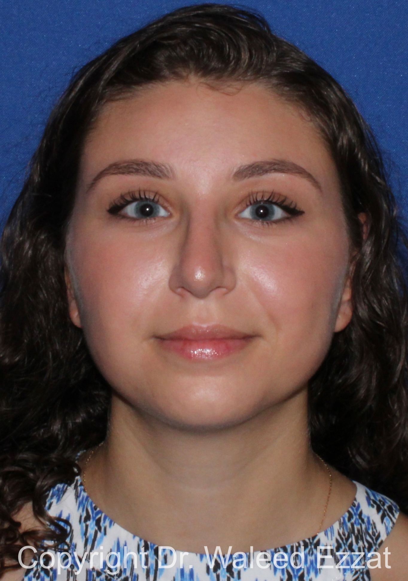 Mediterranean/Middle Eastern Rhinoplasty Patient Photo - Case 653 - after view-2