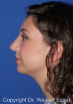 Mediterranean/Middle Eastern Rhinoplasty - Case 653 - After