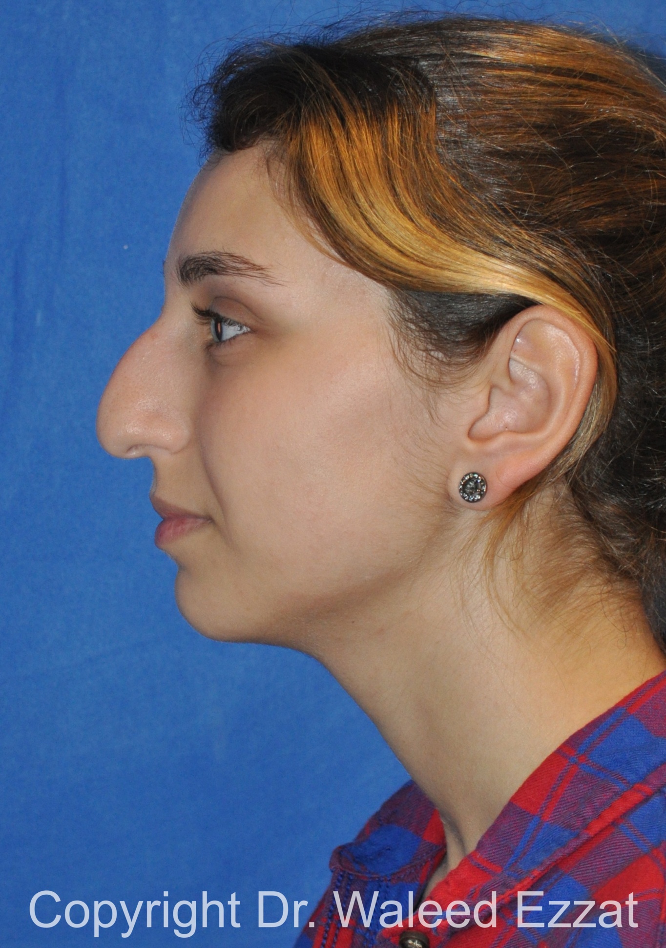 Mediterranean/Middle Eastern Rhinoplasty Patient Photo - Case 653 - before view-