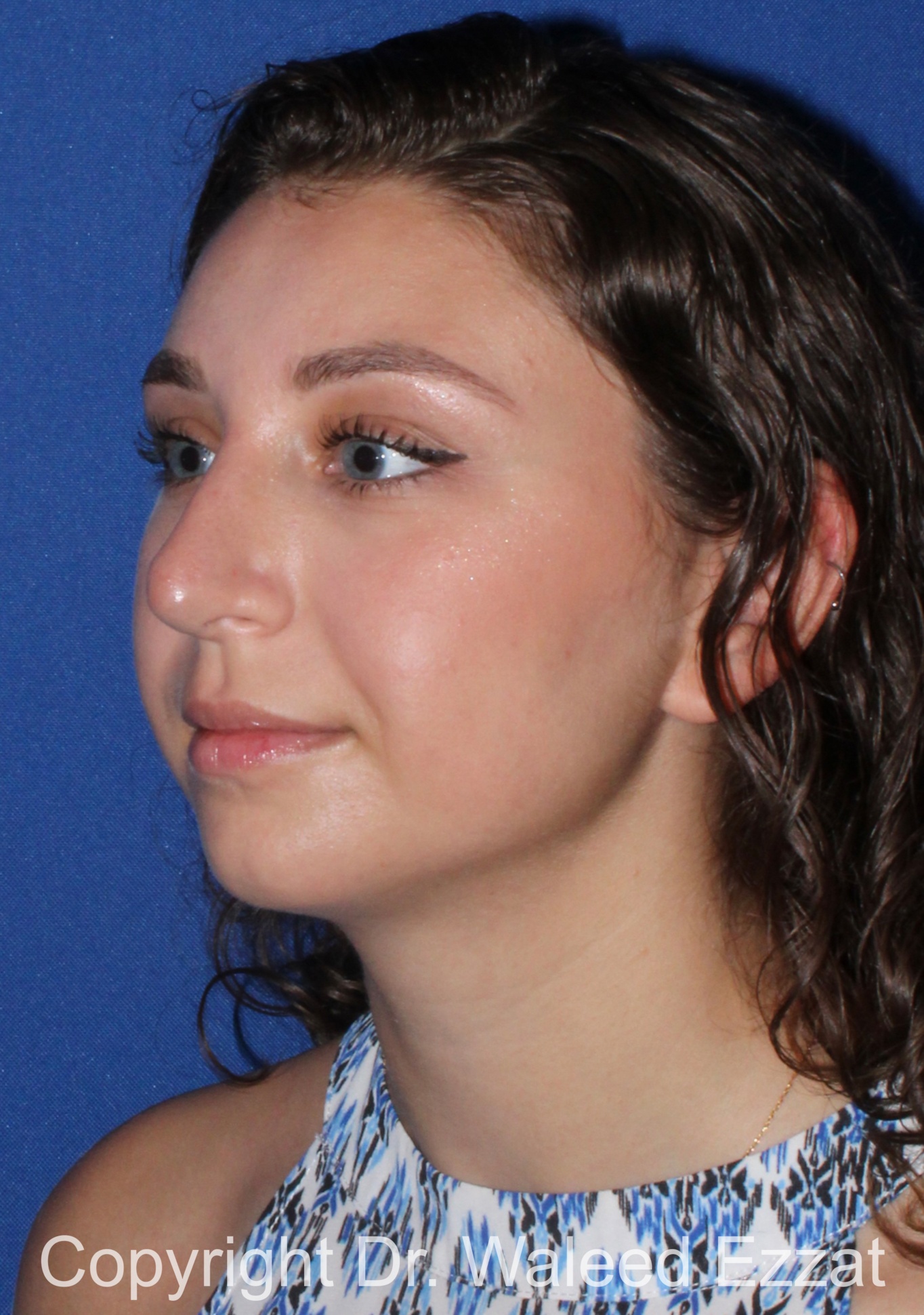 Mediterranean/Middle Eastern Rhinoplasty Patient Photo - Case 653 - after view-1