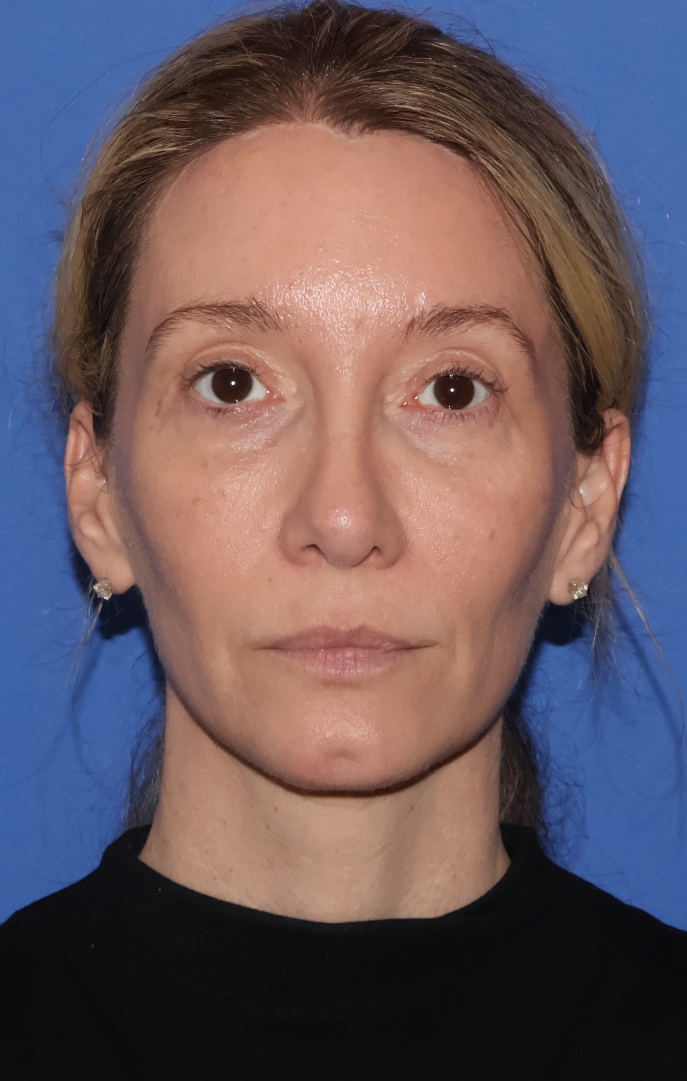 Brow Lift Patient Photo - Case 11001 - after view-1
