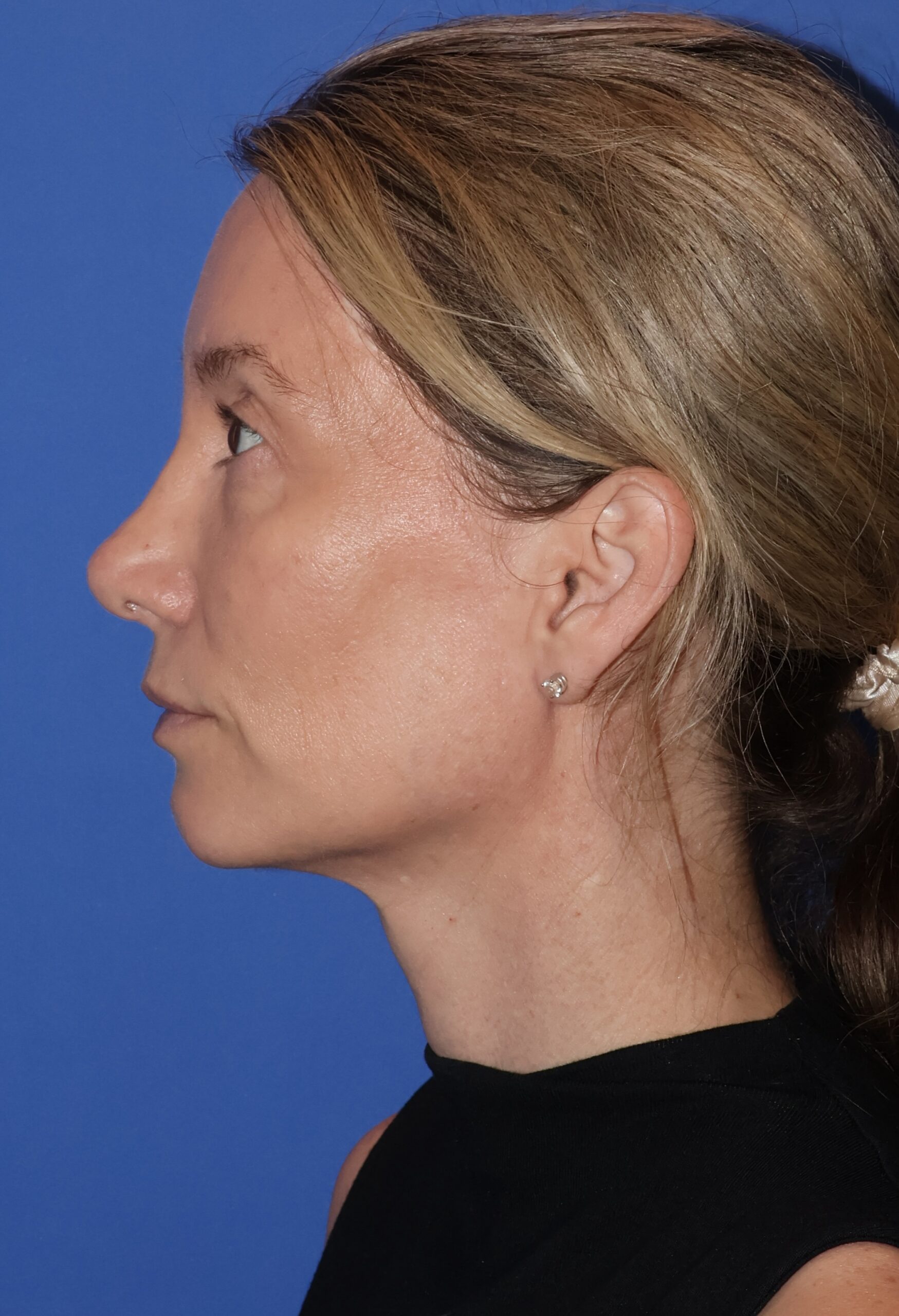 Brow Lift Patient Photo - Case 11001 - after view-2