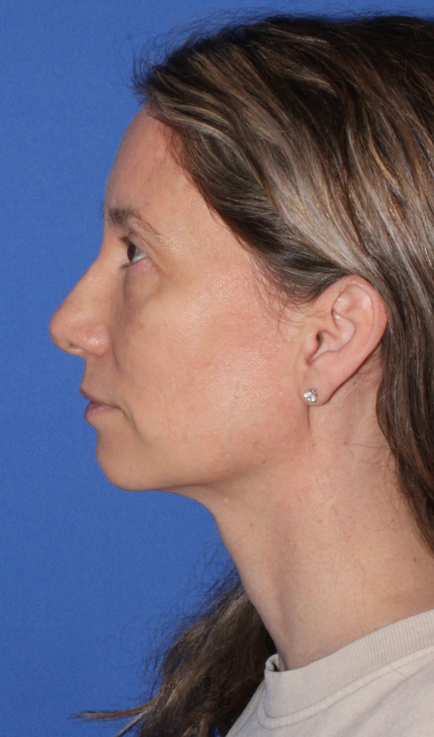 Brow Lift Patient Photo - Case 11001 - before view-2